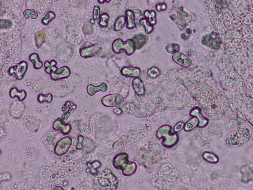 Calcium oxalate monohydrate crystals in a patient with acute kidney injury