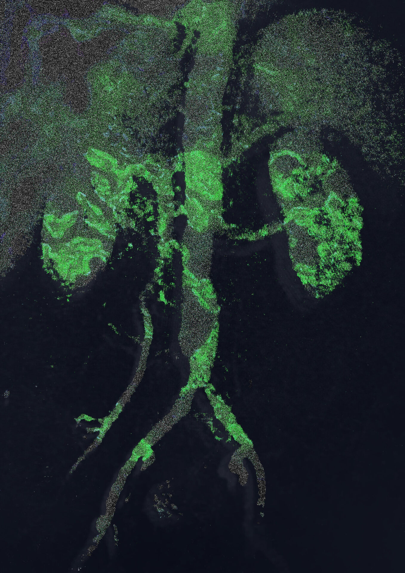 IgA-RVD