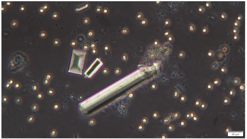 Struvite crystals, bacteria and leucocytes (phase contrast, 400x)